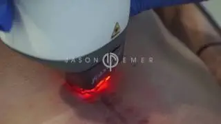 Fraxel Laser | Surgical Scar Revision and Repair | Beverly Hills California
