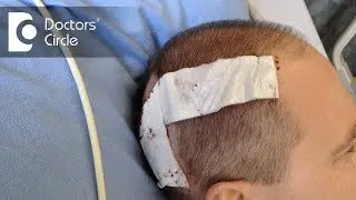 What are the risks in a Craniotomy? - Dr. Bopanna K M