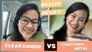 Clear Self ligating braces VS. traditional metal braces. Things I wish I knew before getting damon!