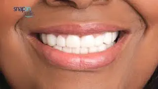 Виниры Snap-On Smile Отзывы