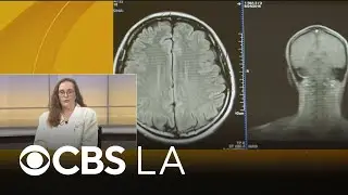 Doctor discusses epilepsy in children and treatment options