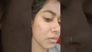 ||my Acne Journey||Thank you Mama earth ||Tea tree face wash &skin correct face serum||