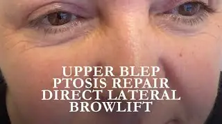 Healing Progress: Direct Lateral Brow Lift, Ptosis Repair & Upper Blepharoplasty