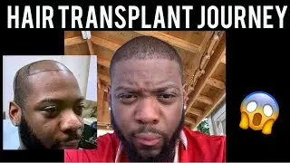Hair Transplant Journey | 4.5 Month update | Monday Motivational&rsquo;s | Black Men | Afro hair type