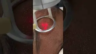This is how Fractional CO2 laser treatment looks like| laser resurfacing #laserskinrejuvenation