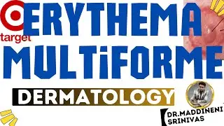 Erythema MultiForme | EMF | Target Lesions | Herpes simplex | Dermatology lectures MBBS | DrMSD |