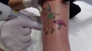 Laser Tattoo Removal with Medlite C6 and Zimmer. www.undo.ink