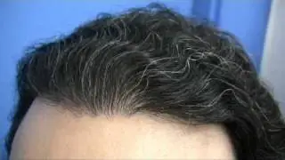Megasession Hair Transplants - 11, 548 Grafts - 3 Sessions