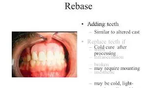 Reline Rebase the RPD