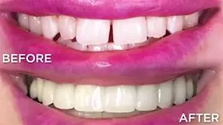 Experience the Same Day Smile Makeover at Milpitas Smile Design