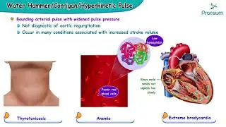 The water hammer pulse or Corrigan (hyperkinetic) pulse || #usmle cardiology