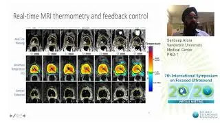 Sandeep Arora - MRI-guided Transurethral US Ablation (TULSA) in Localized Prostate Cancer (2020)
