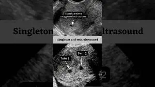 Single Baby Vs Twins on scan 🥰👶 #shortvideo #status