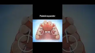 Treatment of Crowding Teeth..#crowding #shorts #trending #youtube