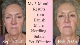 Can Micro-needling Revolutionize Mature Skin? Keep Watching