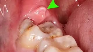 11) wisdom tooth- ડહાપણ ની દાઢ વિશે થોડી માહિતી