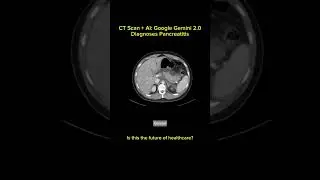 Google Gemini 2.0 is reshaping radiology with Pancreatitis Detection! 🤯🤯