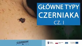 Główne typy czerniaka - cz. 1