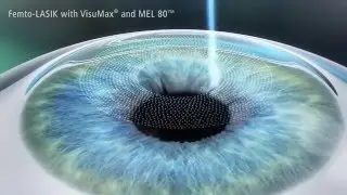 FEMTO-LASIK-Augenlaser Behandlung in Wien und Z&uuml;rich bei EyeLaser (Animation)