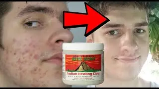 AZTEC HEALING CLAY MASK THE TRUTH!