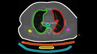 Chest CT Scan Segmentation using DBSCAN | ML-Based Medical AI for Organ Clustering Visualization