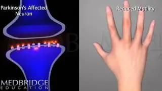 Neuroscience Updates for Right Hemisphere Stroke Video: Martha Burns | MedBridge
