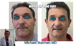 Nose of the Day: Rhinoplasty with breathing improvement in a man