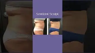 Discover Sentient Sculpt: Advanced Body Contouring Inside Radiant&eacute; Spa 🌟 Unveil the power of Sentie