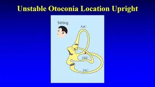 Bascule Manoeuvre in Apogeotropic Posterior Canal BPPV