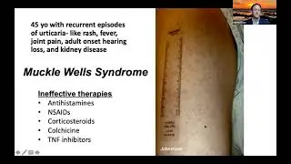 Treatment of Autoinflammation,  Hal Haffman