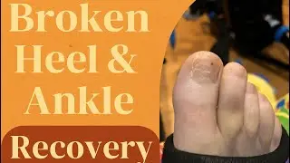 WEEK 3: Struggling With Independence, iWalk Pain & Christmas Chaos | Broken Heel Recovery