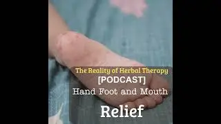 Hand, Foot & Mouth Relief: Herbal Hacks to Soothe Sores Fast