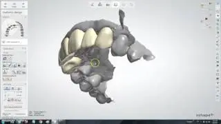 3Shape design for 6 units bridge from Carestream scan