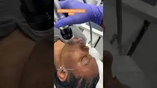 Radiofrequency Microneedling on black skin #blackskincare