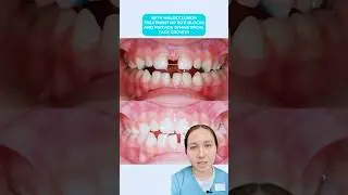 Лечение асимметрии нижней челюсти #дубай #dentalclinic #стоматология #dubai