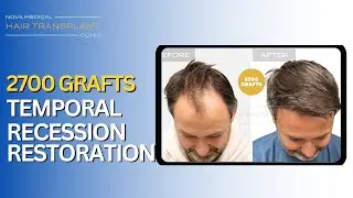 2700 Graft Hair Transplant | Male Hairline & Temporal Recession Restoration