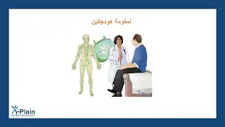 لمفومة هودجكين