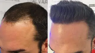 TRASPLANTE CAPILAR 2.520 UF's - Dr XAVIER ALVAREZ - CASOS REALES de DOCTORES
