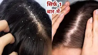 Diy remidy for Dandruff🤩No More Dandruff Get Result in one Wash/Dandruff Solution at home/#hairgrowt