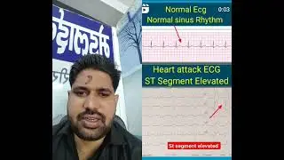 Normal Vs Abnormal ECG report Normal#ECG#Report#viral#@Heart#attack#report#solution