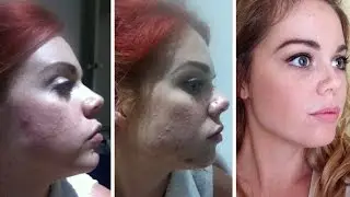 ACNE, STRESS, INTOLERANCES & SKIN CARE - #askRawNourishment