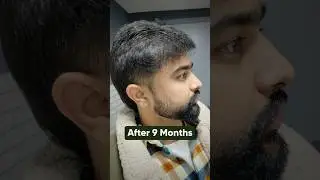 9 Months Hair Transplant Result | Latest Fue Technique #shorts #viral #hair