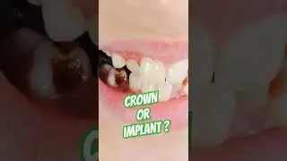 Missing Tooth ? Dental Crown or Dental Implant ? #dentalcrowns #missingtooth #dentalimplants