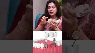Dental Implant vs Tooth Bridge in Telugu | Dr Swetha | Anantra Digital