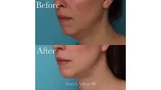 Chin Augmentation Patient's Perspective By Dr Patrick K Sullivan.