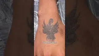 Tattoo Removal Process Started! 3 Tattoos 1st Session | Best Tattoo Removal Agra #lasertattooremoval