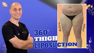 Она наконец увидела свои ноги без липедемы 😱 | 360-градусная липосакция бёдер доктора Джорджа Кар...