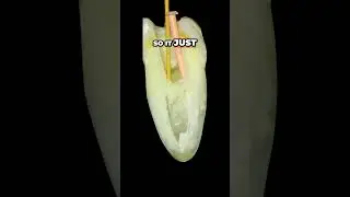 Amazing Dental Hack  See How This Dentist Does Root Canals!