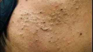 Easy Ways To Remove Blackheads And Whiteheads At Home