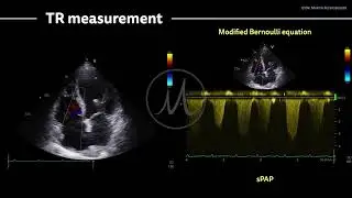 〖Echocardiography〗 Tricuspid regurgitation & sPAP